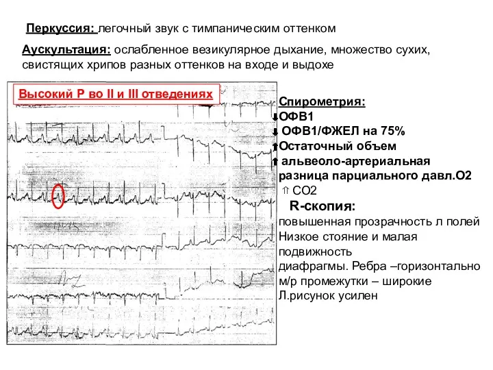 Аускультация: ослабленное везикулярное дыхание, множество сухих, свистящих хрипов разных оттенков