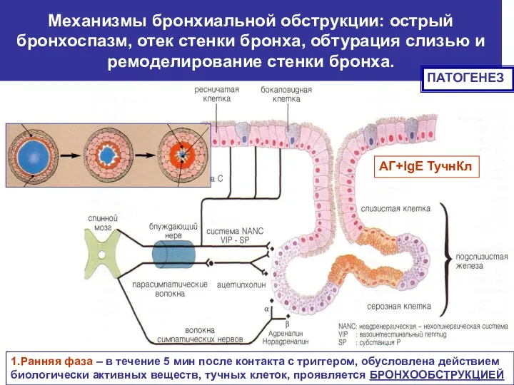 Механизмы бронхиальной обструкции: острый бронхоспазм, отек стенки бронха, обтурация слизью