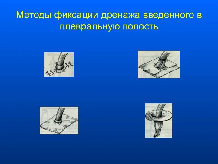 Методы фиксации дренажа введенного в плевральную полость