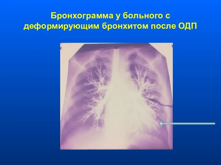 Бронхограмма у больного с деформирующим бронхитом после ОДП