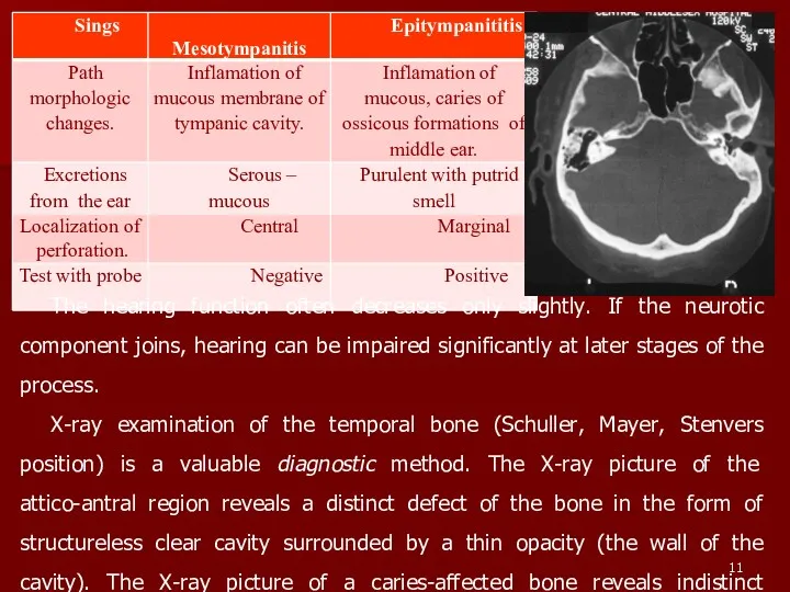 The hearing function often decreases only slightly. If the neurotic component joins, hearing