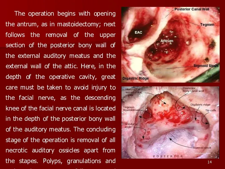 The operation begins with opening the antrum, as in mastoidectomy; next follows the