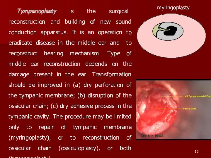 Tympanoplasty is the surgical reconstruction and building of new sound conduction apparatus. It