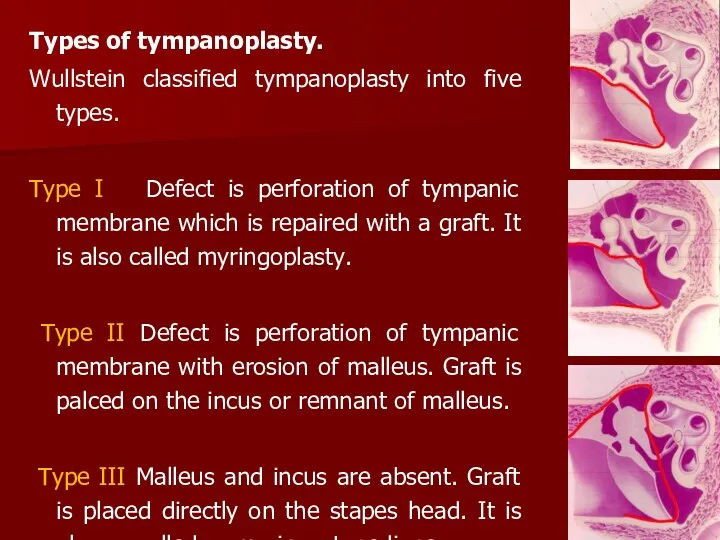 Types of tympanoplasty. Wullstein classified tympanoplasty into five types. Type I Defect is
