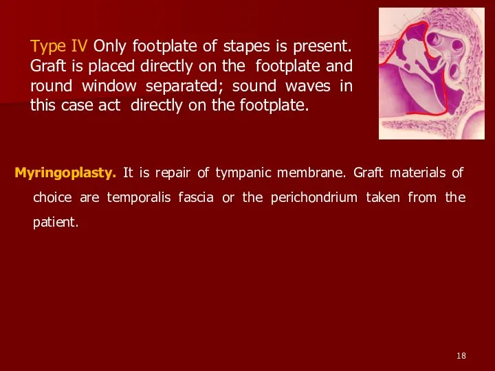 Myringoplasty. It is repair of tympanic membrane. Graft materials of choice are temporalis
