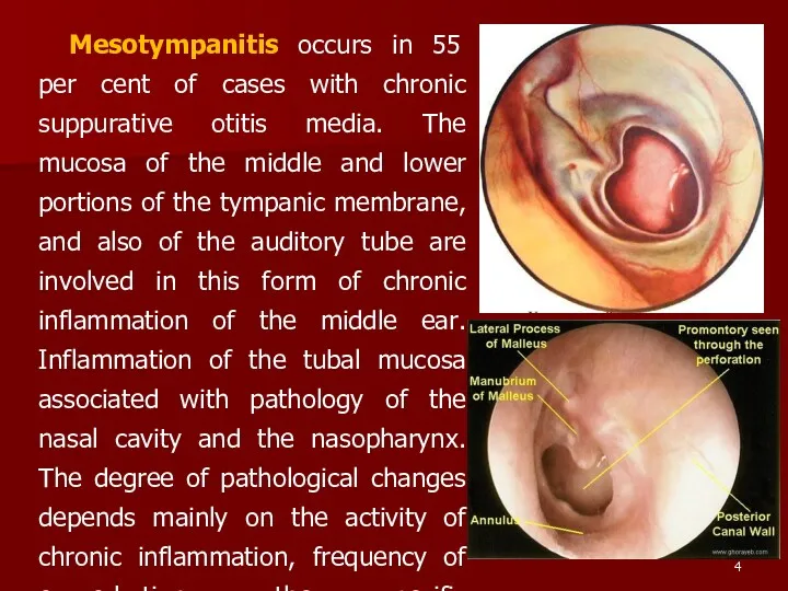 Mesotympanitis occurs in 55 per cent of cases with chronic suppurative otitis media.