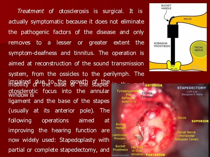 Treatment of otosclerosis is surgical. It is actually symptomatic because