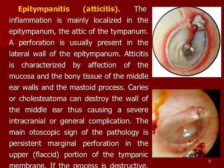 Epitympanitis (atticitis). The inflammation is mainly localized in the epitympanum, the attic of