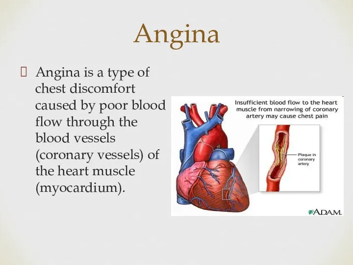 Angina Angina is a type of chest discomfort caused by poor blood flow