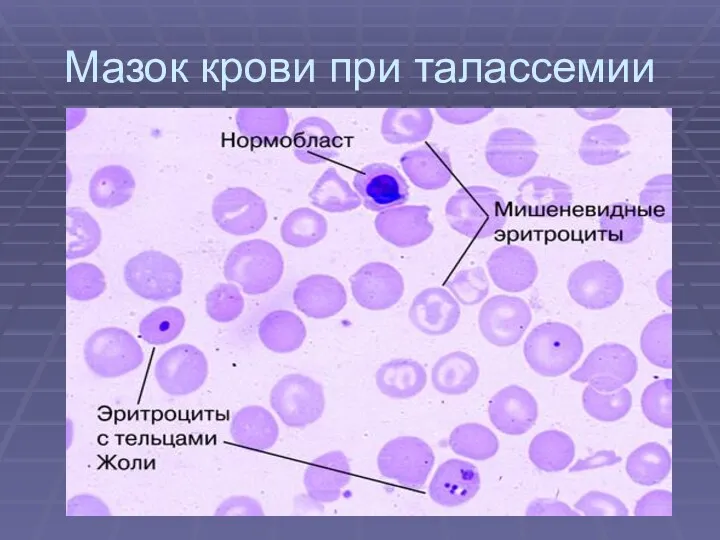 Мазок крови при талассемии