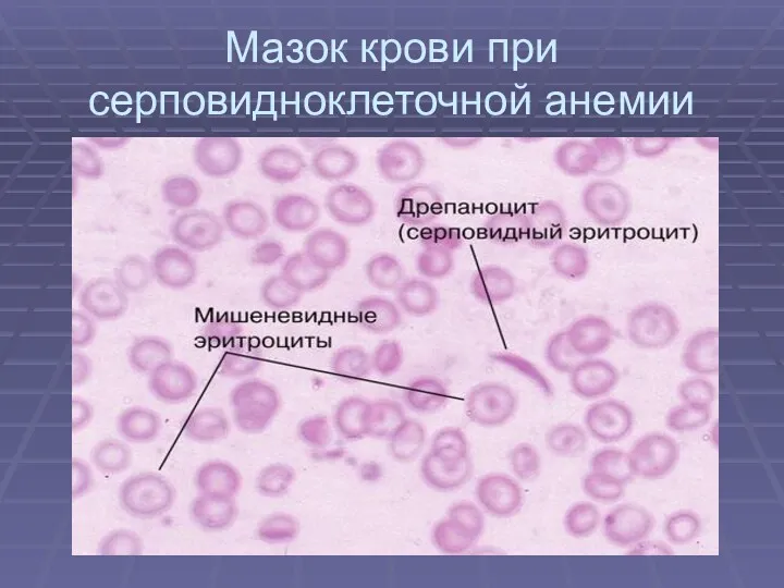 Мазок крови при серповидноклеточной анемии