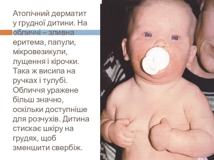 Атопічний дерматит у грудної дитини. На обличчі – зливна еритема, папули, мікровезикули, лущення
