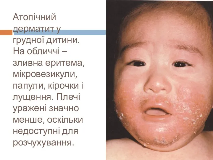 Атопічний дерматит у грудної дитини. На обличчі – зливна еритема, мікровезикули, папули, кірочки