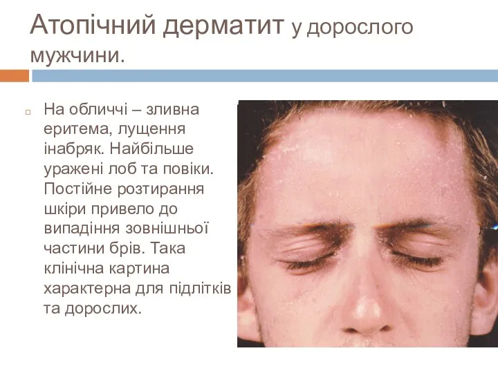 Атопічний дерматит у дорослого мужчини. На обличчі – зливна еритема, лущення інабряк. Найбільше