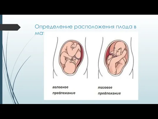 Определение расположения плода в матке: