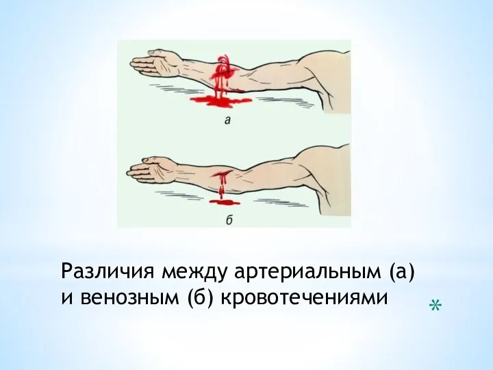 Различия между артериальным (а) и венозным (б) кровотечениями