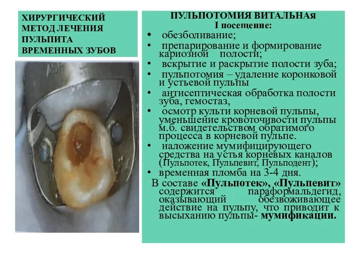 ХИРУРГИЧЕСКИЙ МЕТОД ЛЕЧЕНИЯ ПУЛЬПИТА ВРЕМЕННЫХ ЗУБОВ ПУЛЬПОТОМИЯ ВИТАЛЬНАя I посещение: