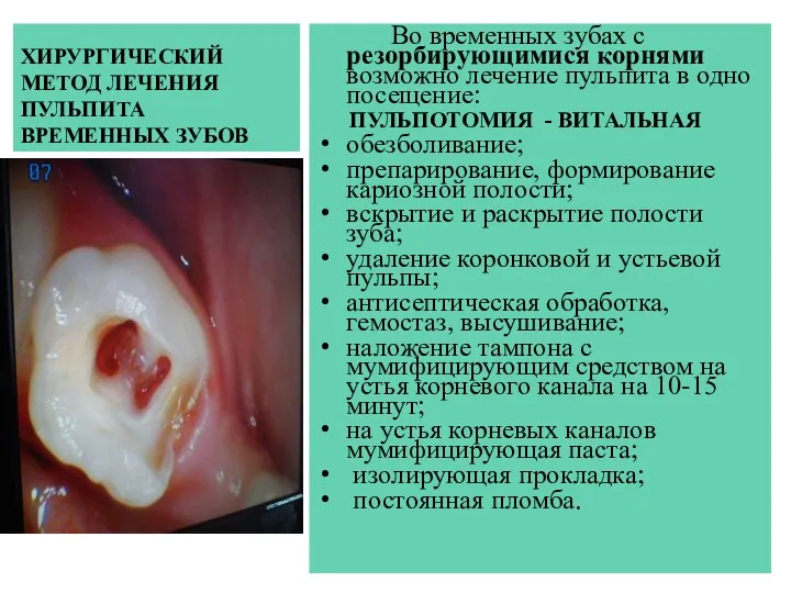 ХИРУРГИЧЕСКИЙ МЕТОД ЛЕЧЕНИЯ ПУЛЬПИТА ВРЕМЕННЫХ ЗУБОВ Во временных зубах с