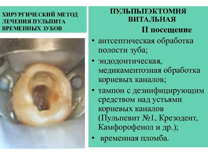 ХИРУРГИЧЕСКИЙ МЕТОД ЛЕЧЕНИЯ ПУЛЬПИТА ВРЕМЕННЫХ ЗУБОВ ПУЛЬПЬПЭКТОМИЯ ВИТАЛЬНАЯ II посещение