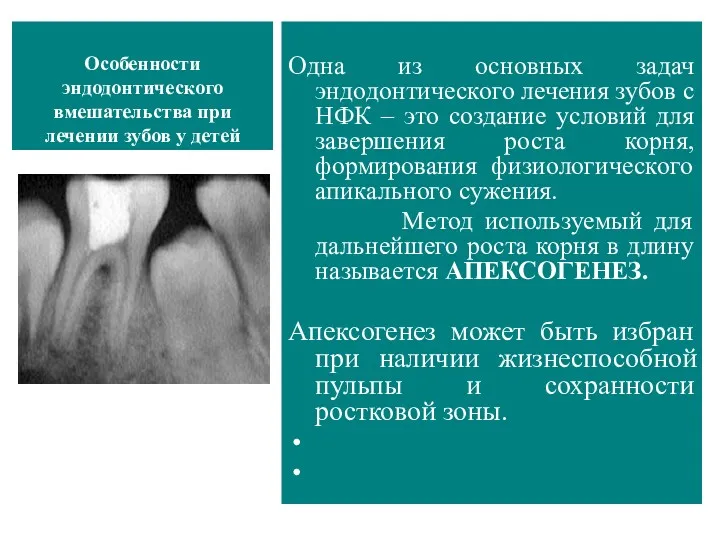Особенности эндодонтического вмешательства при лечении зубов у детей Одна из