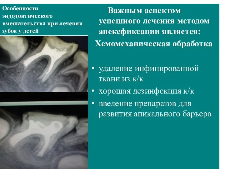 Особенности эндодонтического вмешательства при лечении зубов у детей Важным аспектом