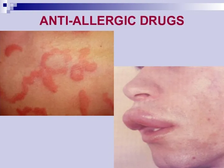 ANTI-ALLERGIC DRUGS