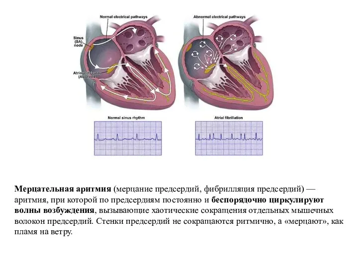 Мерцательная аритмия (мерцание предсердий, фибрилляция предсердий) — аритмия, при которой