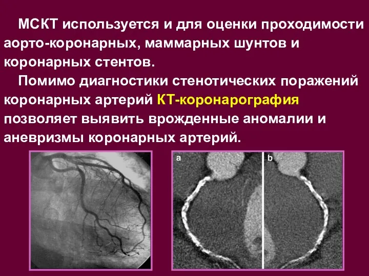 МСКТ используется и для оценки проходимости аорто-коронарных, маммарных шунтов и