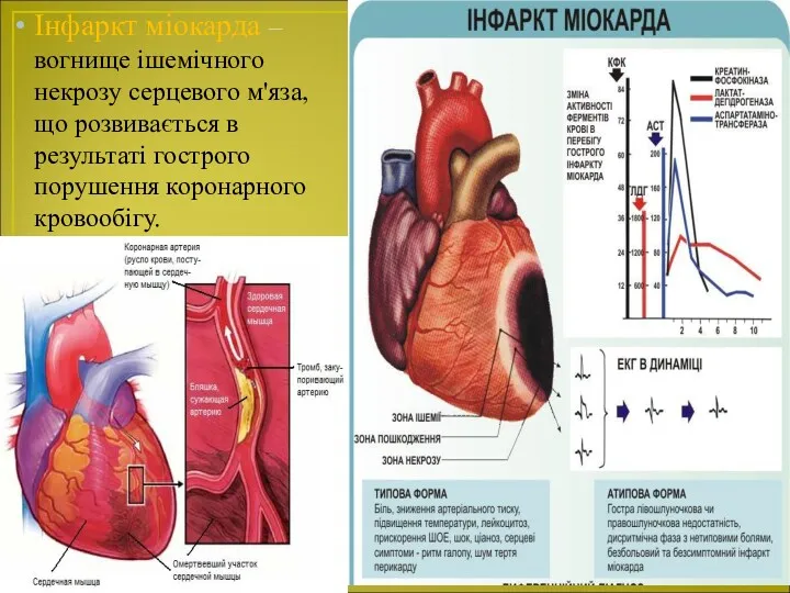 Інфаркт міокарда – вогнище ішемічного некрозу серцевого м'яза, що розвивається в результаті гострого порушення коронарного кровообігу.