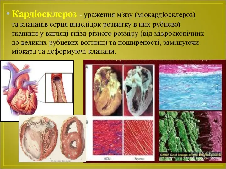 Кардіосклероз - ураження м'язу (міокардіосклероз) та клапанів серця внаслідок розвитку в них рубцевої