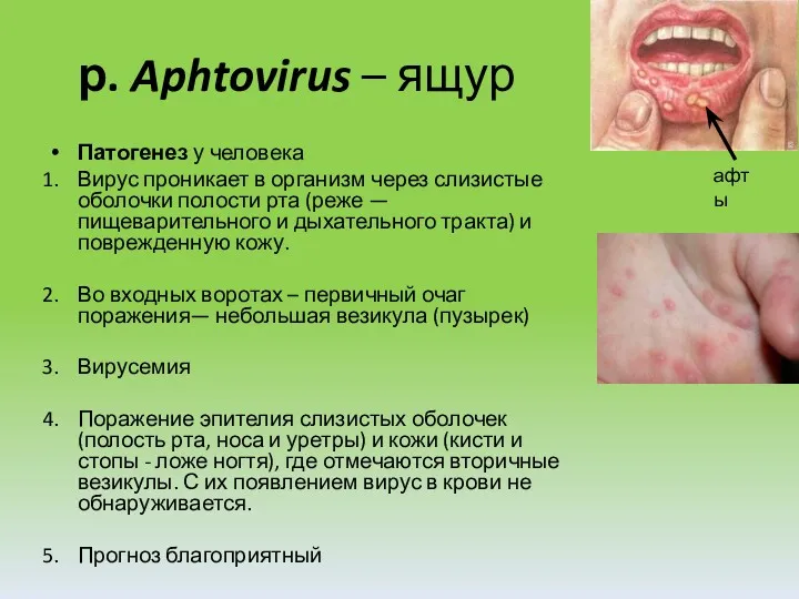 р. Aphtovirus – ящур Патогенез у человека Вирус проникает в организм через слизистые