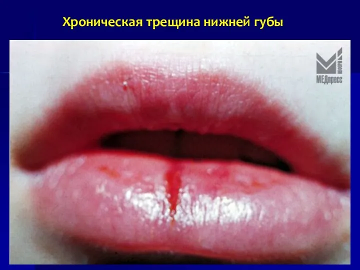 Хроническая трещина нижней губы