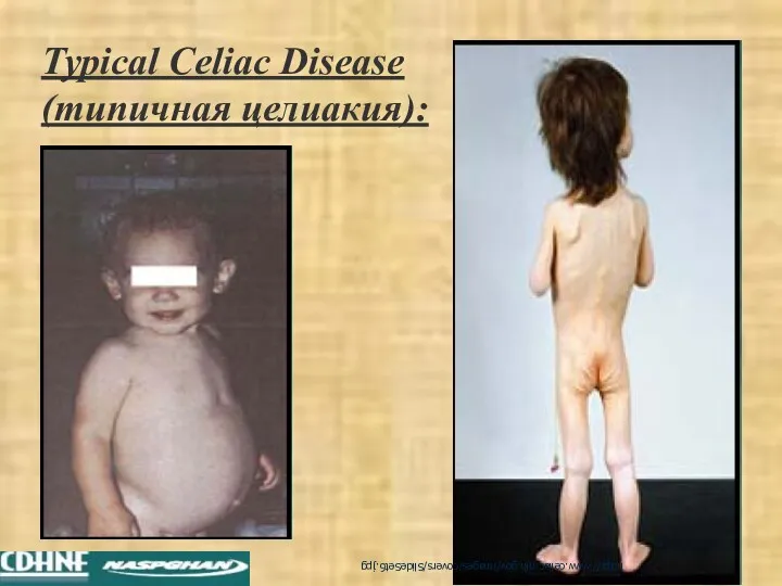 Typical Celiac Disease (типичная целиакия): http://www.celiac.nih.gov/images/covers/SlideSet6.jpg