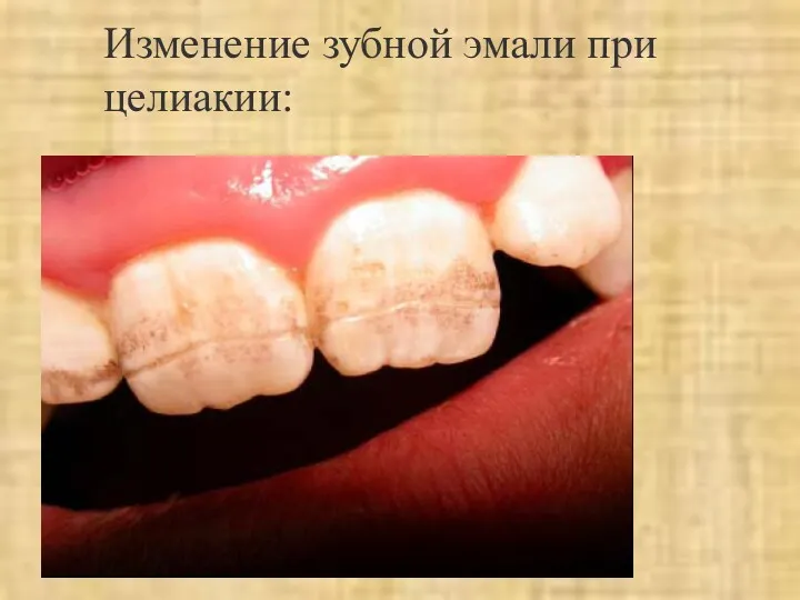Изменение зубной эмали при целиакии: