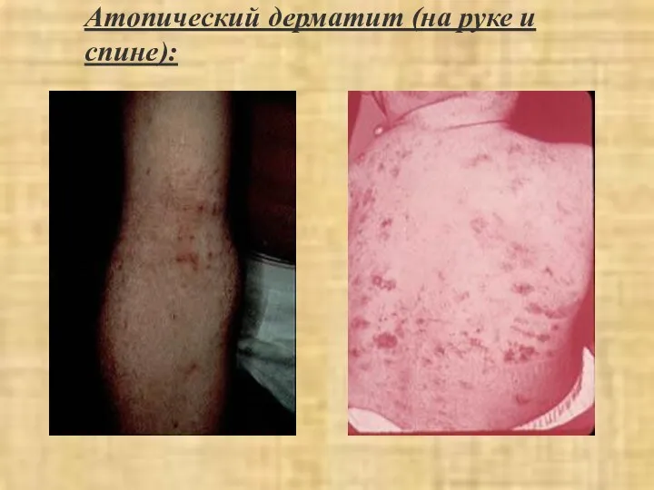 Атопический дерматит (на руке и спине):