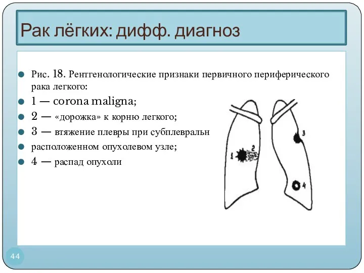 Рак лёгких: дифф. диагноз Рис. 18. Рентгенологические признаки первичного периферического рака легкого: 1