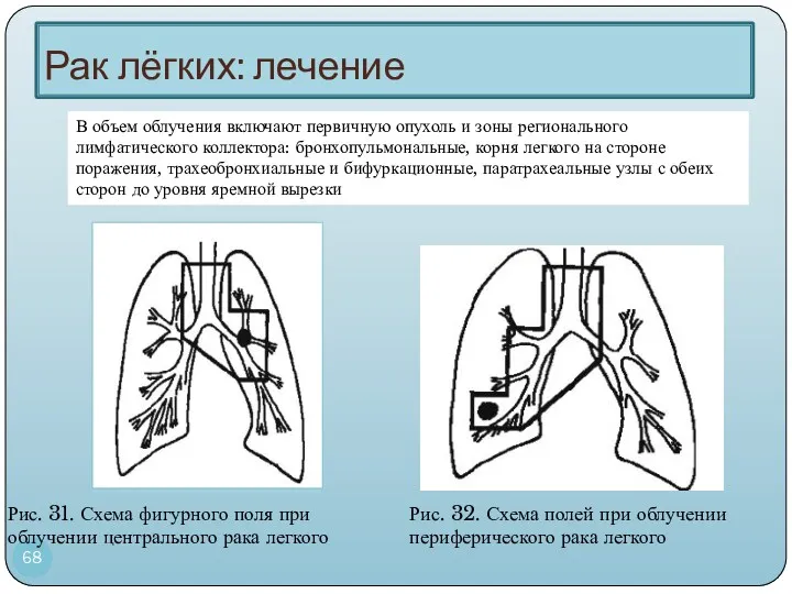 Рак лёгких: лечение Рис. 31. Схема фигурного поля при облучении центрального рака легкого