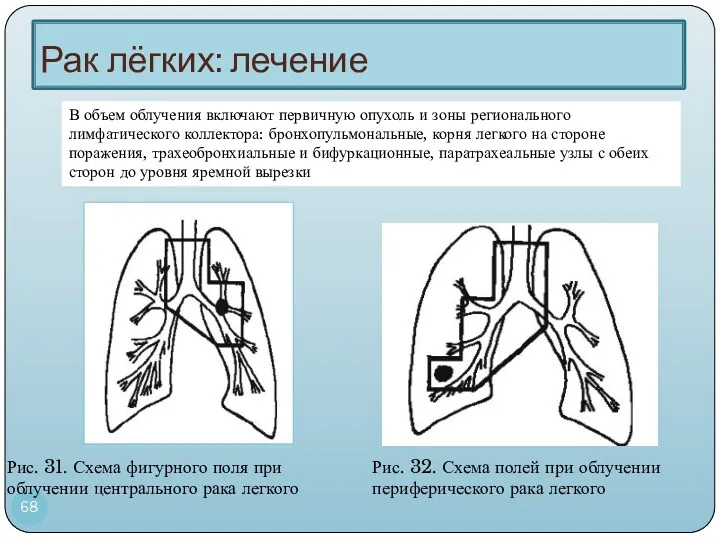 Рак лёгких: лечение Рис. 31. Схема фигурного поля при облучении