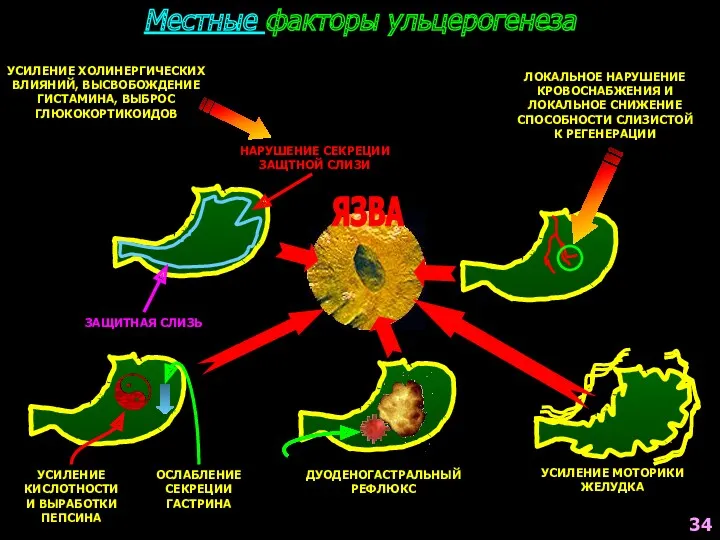 Местные факторы ульцерогенеза ЗАЩИТНАЯ СЛИЗЬ НАРУШЕНИЕ СЕКРЕЦИИ ЗАЩТНОЙ СЛИЗИ УСИЛЕНИЕ