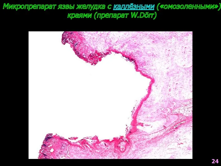 Микропрепарат язвы желудка с каллёзными («омозоленными») краями (препарат W.Dörr) 24