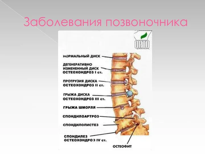 Заболевания позвоночника