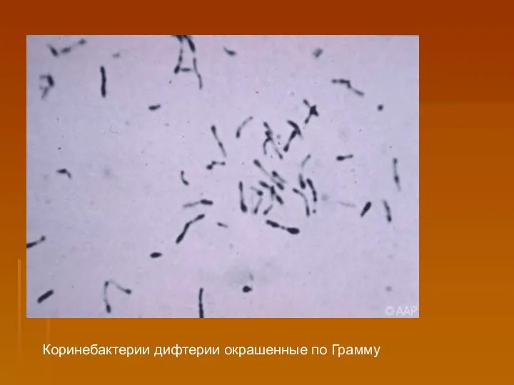 Коринебактерии дифтерии окрашенные по Грамму