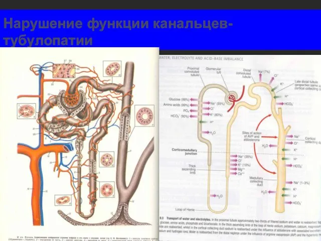 Нарушение функции канальцев- тубулопатии