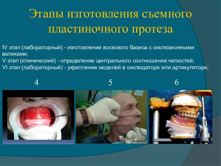 Этапы изготовления съемного пластиночного протеза IV этап (лабораторный) - изготовление