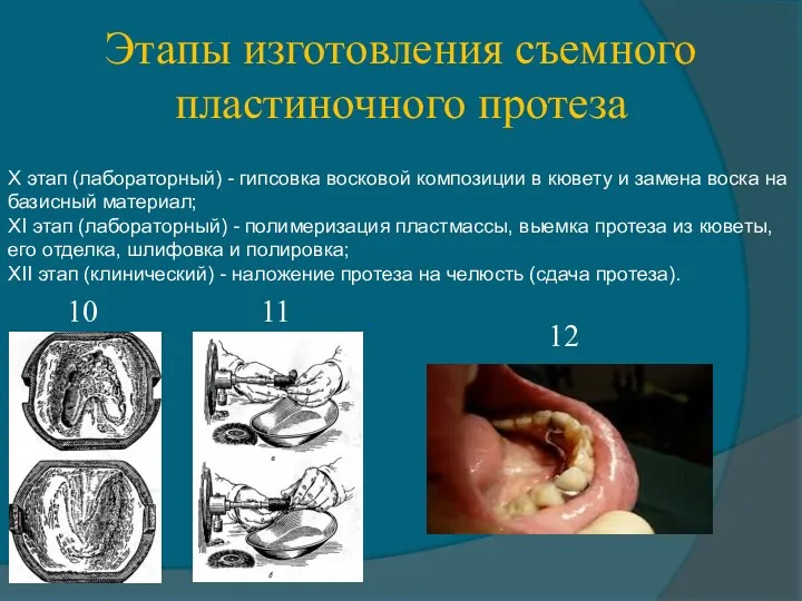 Этапы изготовления съемного пластиночного протеза X этап (лабораторный) - гипсовка