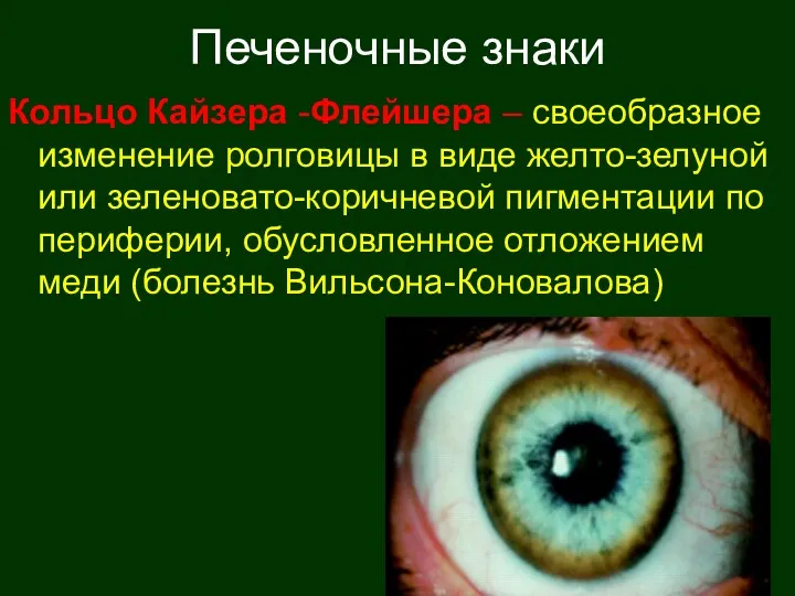 Печеночные знаки Кольцо Кайзера -Флейшера – своеобразное изменение ролговицы в