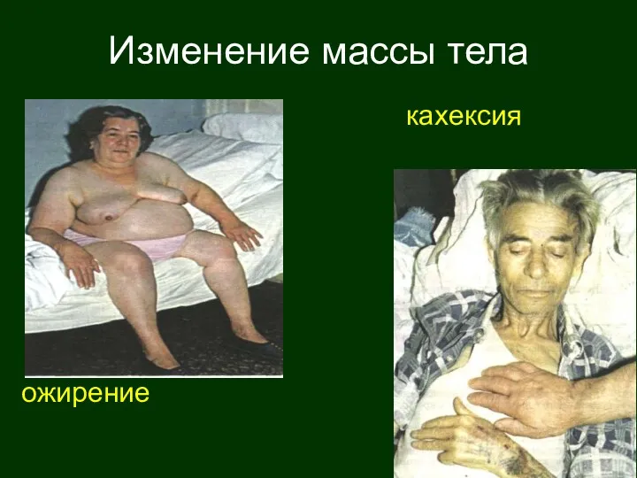 Изменение массы тела кахексия ожирение