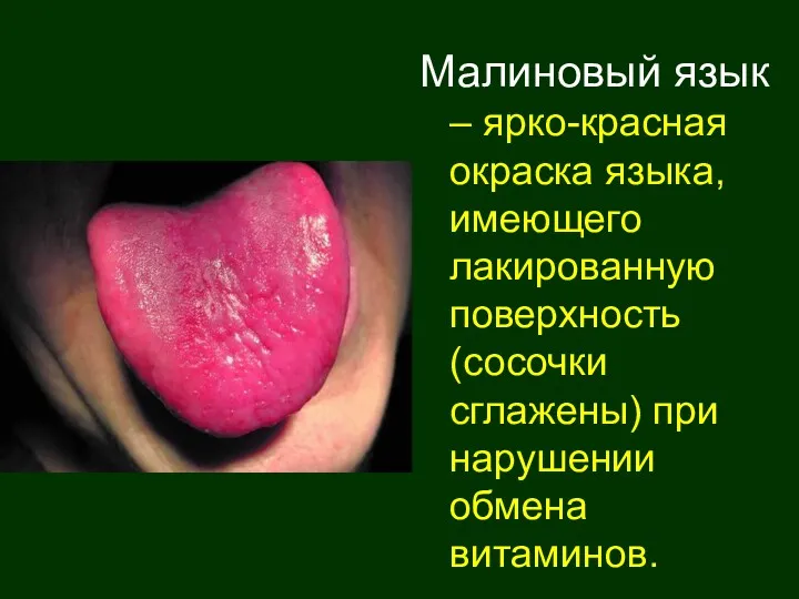 Малиновый язык – ярко-красная окраска языка, имеющего лакированную поверхность (сосочки сглажены) при нарушении обмена витаминов.