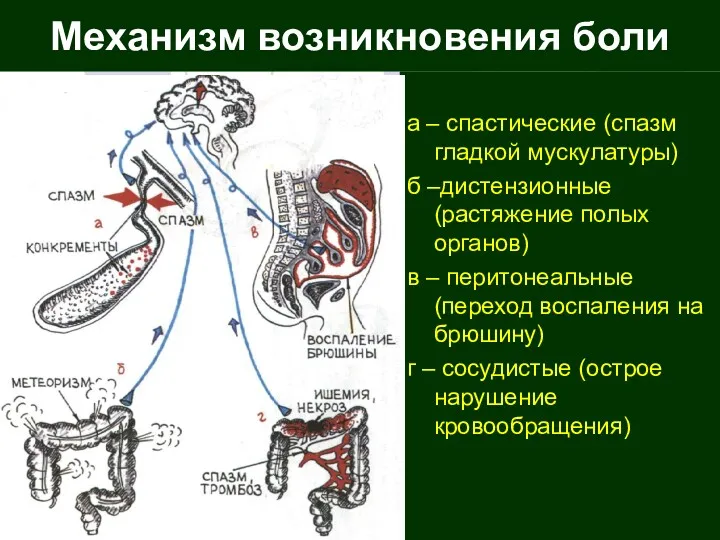 Механизм возникновения боли а – спастические (спазм гладкой мускулатуры) б –дистензионные (растяжение полых