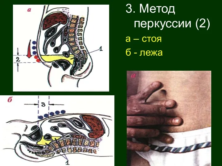 3. Метод перкуссии (2) а – стоя б - лежа